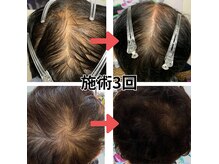 パイシーズ(Pisces)の雰囲気（5回施術推薦ですが、3回でこれだけ育毛促進したお客様もいます！）
