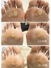 ペディラボ 荻窪店(Pedi Labo)/たこ・魚の目徹底ケア症例（１）