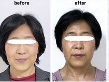 サロンスマイル/50代美容鍼ビフォーアフター