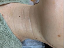 ブルーココア(BlueCocoa)/溶けるコラーゲン糸リフト