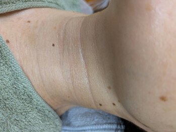 ブルーココア(BlueCocoa)/溶けるコラーゲン糸リフト