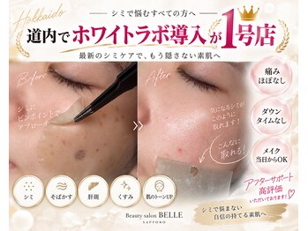 ベル(BELLE)の写真/道内先駆け導入◎話題のシミケア《ホワイトラボ》スタート!短期間で圧倒的効果を実感!長年のシミの悩みに☆