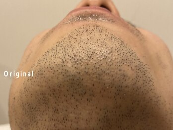 オアシスラグーン(OASIS LAGOON)/メンズ脱毛(症例6:before)