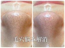 ピエル 北千住店(PIEL)/毛穴悩み解消