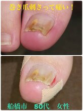 巻き爪じゅん 千葉駅前店/巻き爪が刺さって痛い！