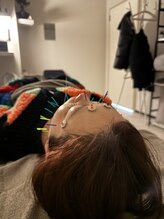 ラフテル鍼灸整骨院/ピーリングより時短の美容鍼！