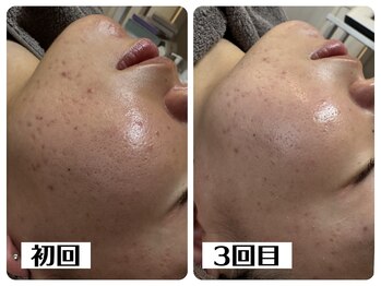 ハオン(HAON)/ハーブピーリング/ニキビ/毛穴