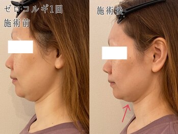 サロン カピリナ(salon Kapilina)/【before→after】