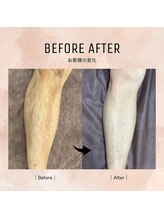 ルミエールブランシュ(Lumiere blanche)/足脱毛