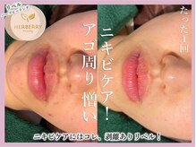 ハーバリー ハーブピーリング 金山店(HERBERRYハーブピーリング)/名古屋ハーブピーリングHERBERRY