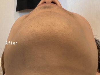 オアシスラグーン(OASIS LAGOON)/メンズ脱毛(症例6:after)