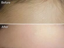 オーシャンブルー 時津店(OCEAN BLUE)/キッズ脱毛《おでこ》