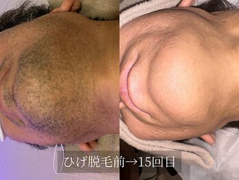 アルム(Arum)/ひげ脱毛