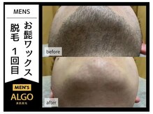 アルゴ 福井店(ALGO)/光×ワックスで青髭から解放！