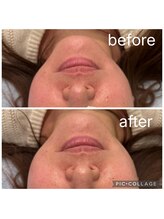 レイモード(Ray mode)/BBLフェイシャル＆パック