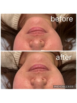 レイモード(Ray mode)/BBLフェイシャル＆パック