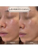 ロエン(Roen)/植物幹細胞でお肌の細胞を休息