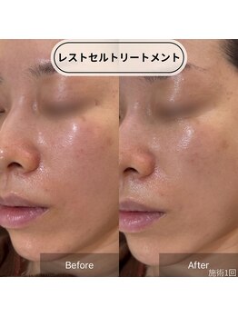 ロエン(Roen)/植物幹細胞でお肌の細胞を休息