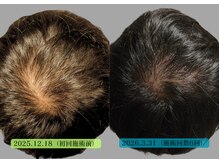 やなけん 亀戸店の雰囲気（髪の毛や頭皮のお悩みには「育毛促進鍼+LED」）