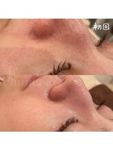 プルメリア(Plumer’a)/お顔全体の毛穴大掃除☆肌質改善