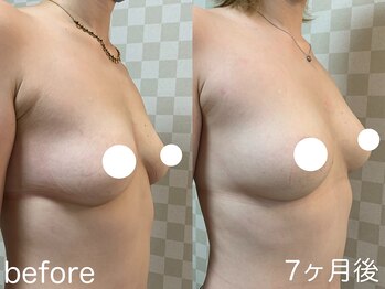 ハレオラ(HaleOla)/30代☆バストケア