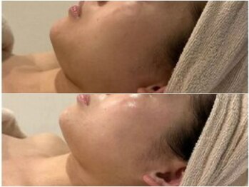 サロン ド ブラン アオヤマ(Salon de BLANC AOYAMA)/クリスティーナハーブピーリング