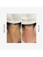 ブランスキンラボ(BLANC.skin LAB)/うなじワックス脱毛