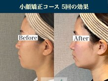 キュープ 表参道店(Qpu)/小顔矯正5回コースの変化