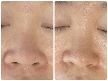 ラヴィ(Ravi)/毛穴開きホームケアで改善難しい