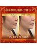 【顎下脂肪・目の下脂肪たるみ　小顔】レッドショット