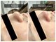 リアライズ(realise)の写真/黒ずみ毛穴さよなら!美容鍼とハイドロ毛穴洗浄で、透明感あふれる明るい素肌へ導きます◎