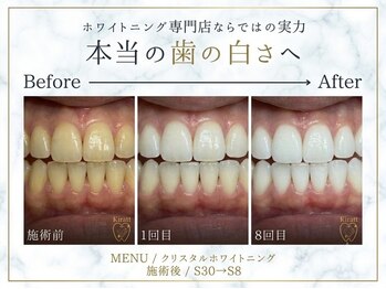 キラット 横浜店(Kiratt)の写真/【初めての方必見】歯科衛生士による丁寧なカウンセリングで、不安を解消し理想の白い歯へ導きます♪