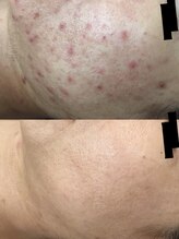 リラクゼーションエステ モア(MORE)/お肌の悩みお気軽にご相談を