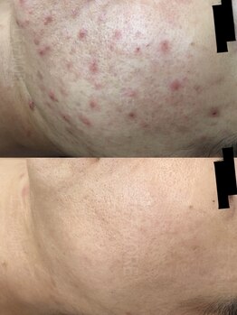 リラクゼーションエステ モア(MORE)/お肌の悩みお気軽にご相談を