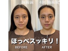 サス(SASU)/つまめる肉ほっぺありませんか？