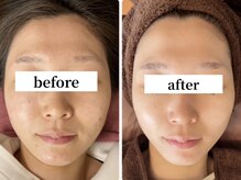 ハーブピーリング 恵比寿/ニキビ/肌質改善