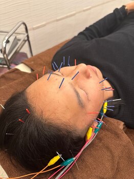 長寿鍼灸院 長寿整骨院/★今日から俺はmen's美容鍼★