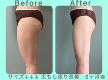 ビーナイス ビューティー(Be Nice Beauty)/太もも★セルシボウ★排出促進！