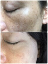 フェルン(FERUN)/日焼け跡のシミの経過