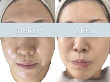 アイビューティー インクリース 和泉店(Eye beauty increase)/プラチナピーリング