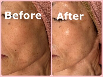 スイ 昭島店(Sui)/ハーブピーリング/シミケア/美白