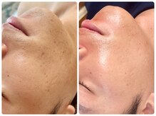 シシエル(CHICIEL)/ヒゲ脱毛で美肌になる♪