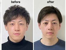 サロンスマイル/30代美容鍼ビフォーアフター