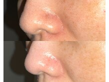 ル シーニュ/毛穴エクストラクション