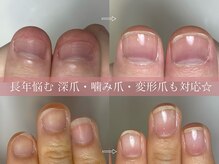 自爪育成資格所有！見た目が変わる！爪のコンプレックス解消◎
