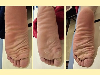 はりきゅう和 ルート鍼灸院/足の変化