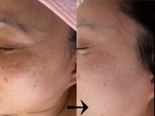 サロン ドロップ 上小田井(Salon drop)/「シミ改善」途中経過