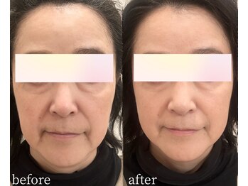 マーリィズエステティック(MARLEY'S AESTHETIC)の写真/年齢サインにアプローチ!ハイブリッドマシンでリフト◎若々しい輪郭へ導く、あなただけの特別ケア☆