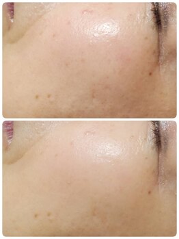 プレイス 太融寺店(PLACE)/ハーブピーリング