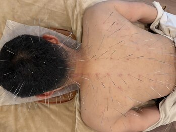 ツボミ(tubomi)の写真/ルート鍼で深層の詰まりをとる！